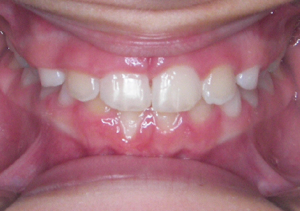 Lower tooth biting outside of the upper teeth