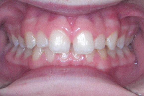Orthodontic Patient 3