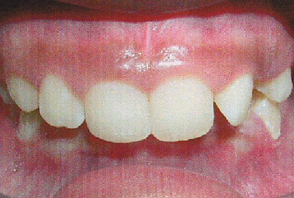 Orthodontic Patient 4