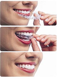 Invisalign Smile - removing aligner from mouth